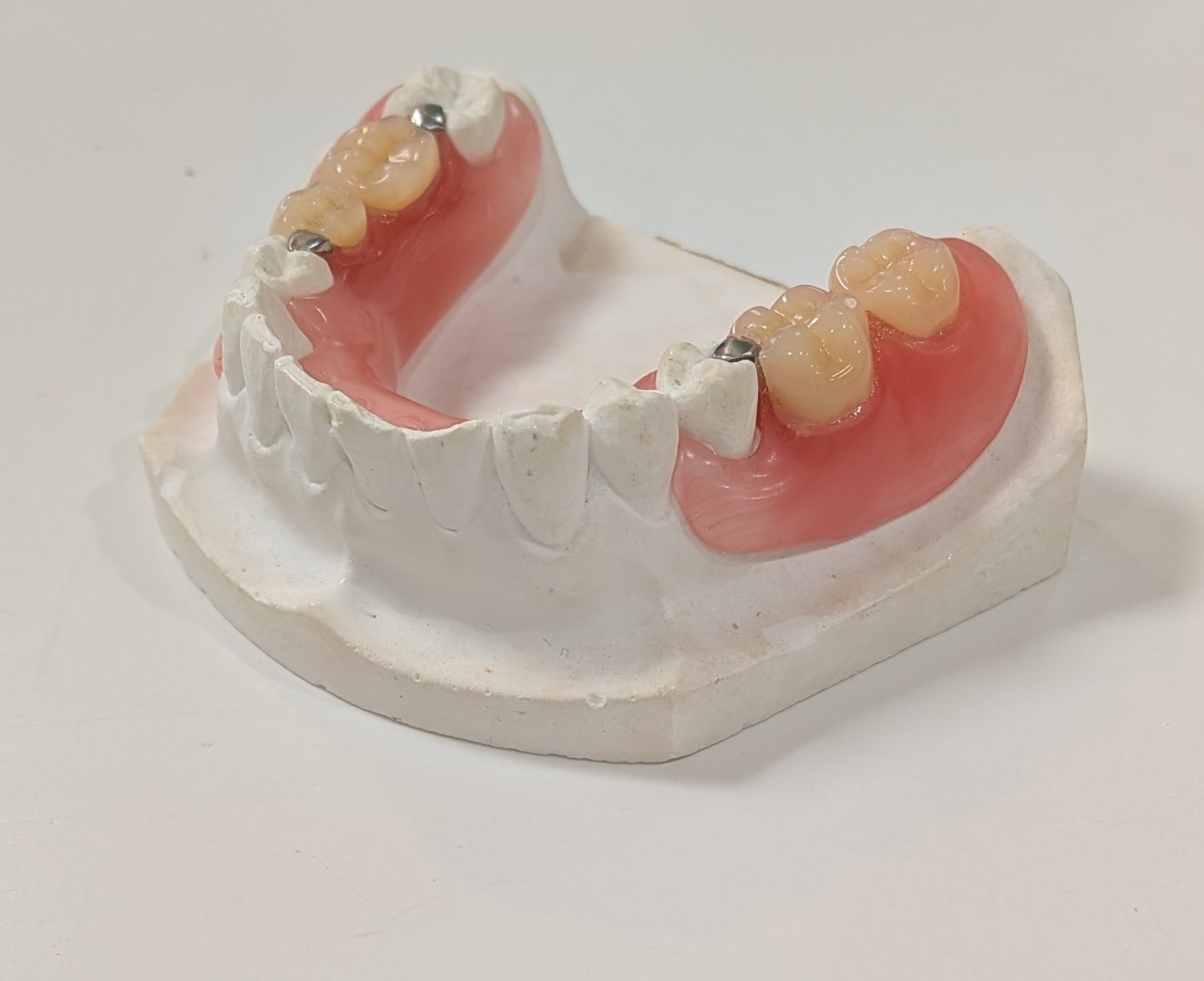 ノンクラスプ