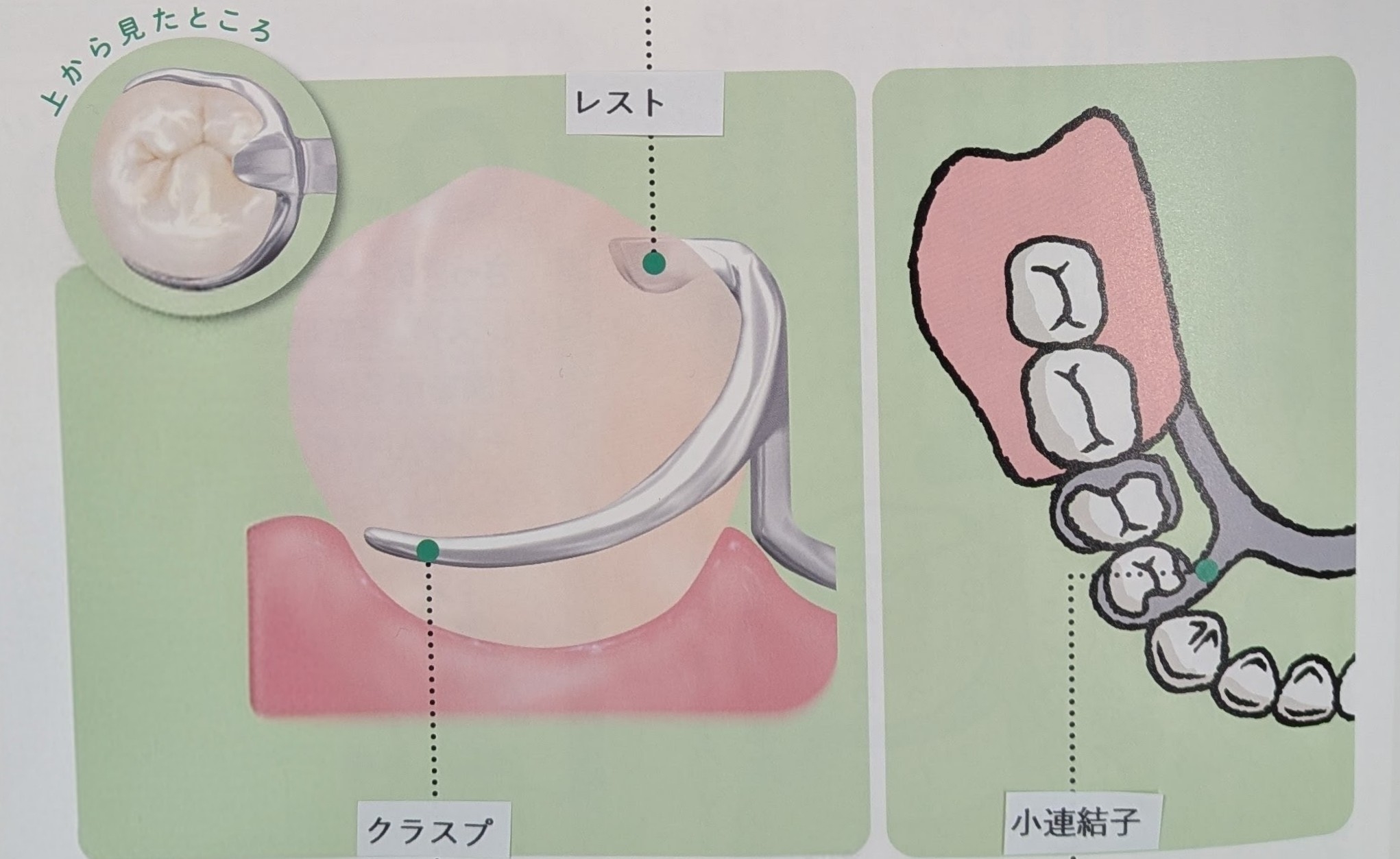 クラスプ