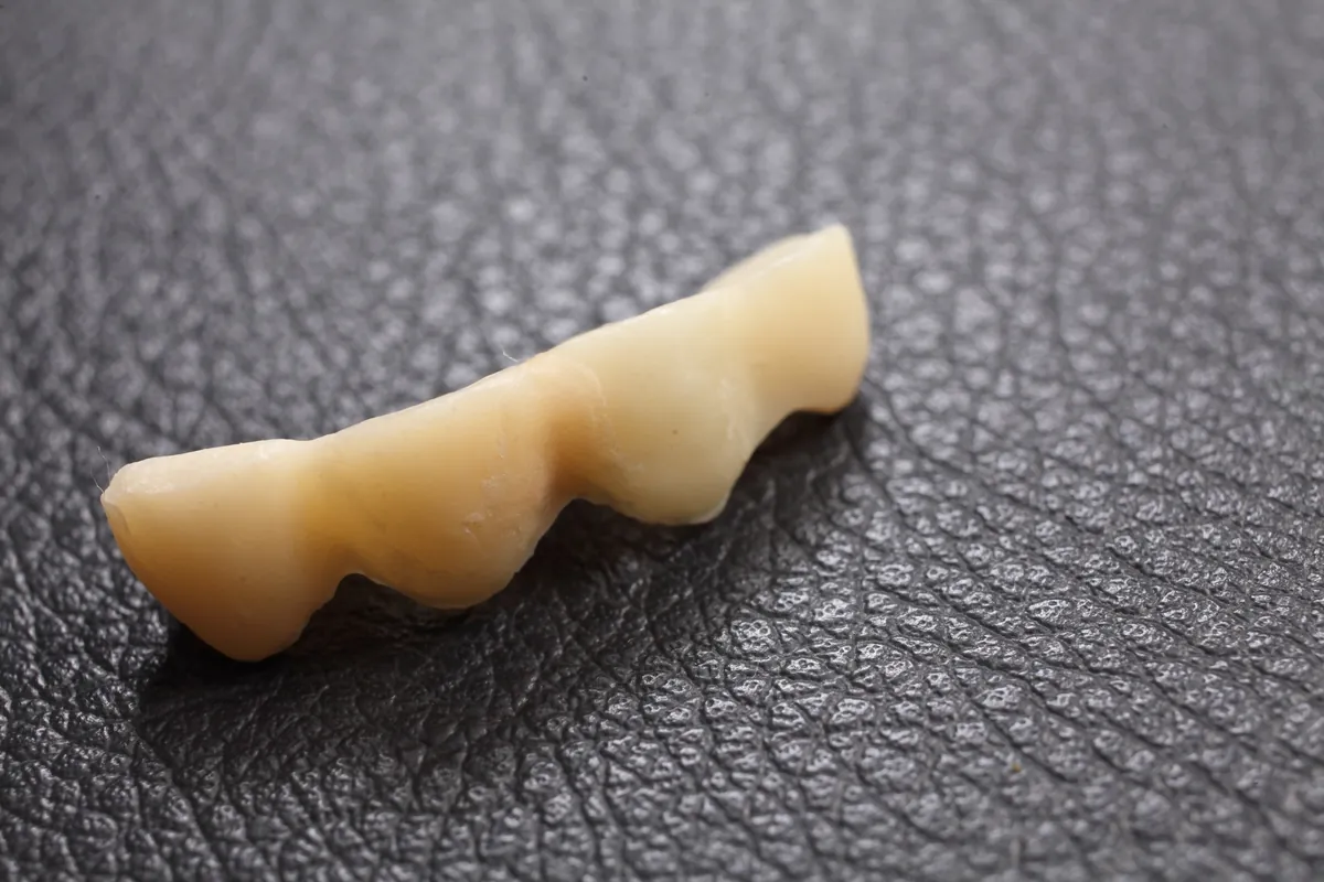 前歯の仮歯（プロビジョナルレストレーション）