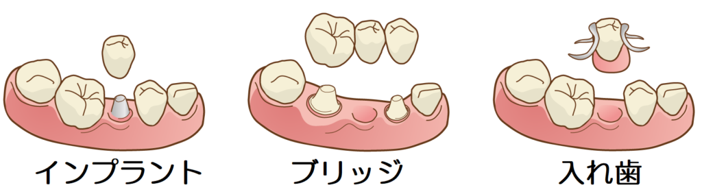 歯は抜けたままでも大丈夫??の掲載画像