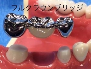 歯を抜いた後の治療についての掲載画像