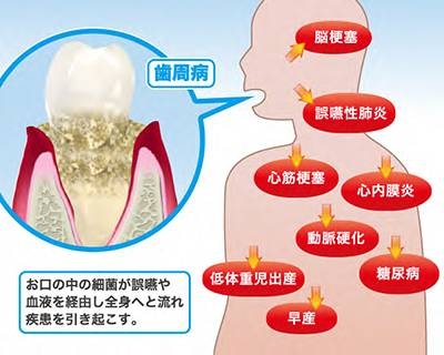 歯周病が全身に及ぼす影響についての掲載画像
