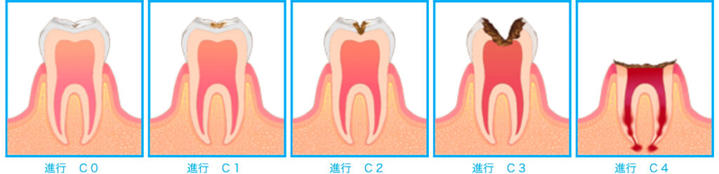 虫歯とはどんな状態ですか?の掲載画像