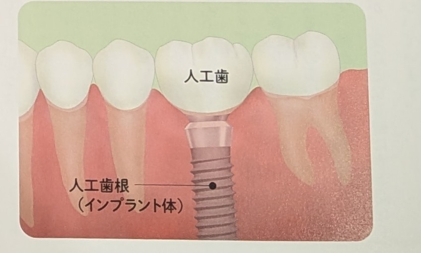 部分入れ歯についての掲載画像