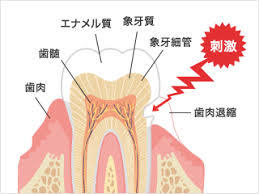 冷たい水がしみます。知覚過敏ですか？の掲載画像