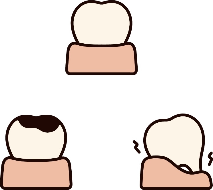 「抜歯をする場合」についての掲載画像